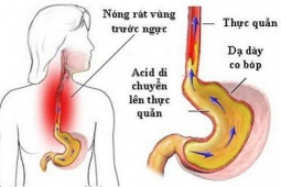 1735916753-547-thumbnail-width740height495_anh_cat_3_2 Người phụ nữ 30 tuổi bị loét hoàn toàn thực quản vì một sai lầm nhiều người Việt mắc phải khi uống thuốc