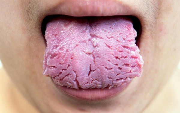 Những dấu hiệu ở lưỡi cảnh báo vấn đề sức khỏe đáng lo ngại mà nhiều người bỏ qua - 3