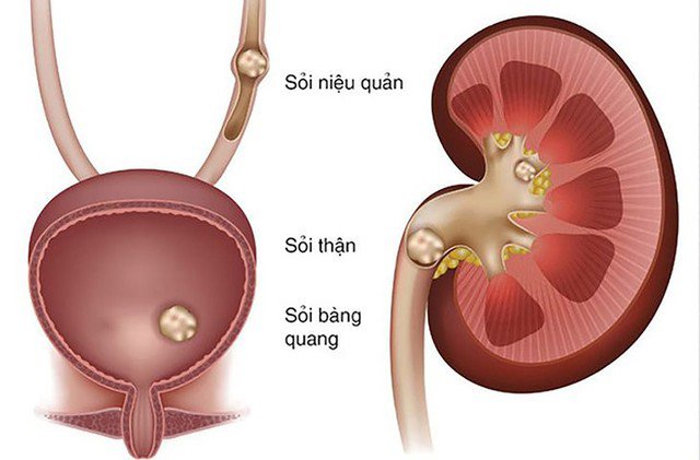 Chế độ ăn uống không khoa học là một nguyên nhân quan trọng dẫn đến nguy cơ hình thành sỏi thận.