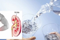 adt1705616628-soi-than-1-1696824851262119894402-0-__anh_cat_3_2 Người bị sỏi thận nên uống bao nhiêu nước mỗi ngày?