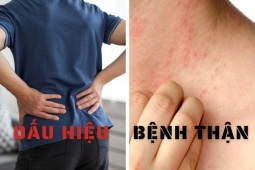 d-u-hi-u-c-a-b-nh-th-n-1705302197-727-width740height495 Bệnh thận được ví là “kẻ giết người thầm lặng” nhưng có thể phát hiện sớm nhờ 5 biểu hiện này