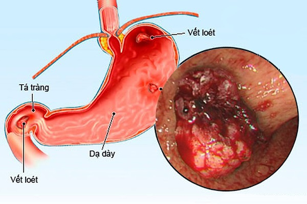 Cảnh báo viêm loét dạ dày – tá tràng: Nhận biết sớm để điều trị kịp thời, tránh biến chứng - 1